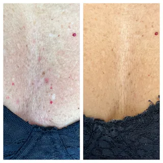 Bioinduzione di collagene — foto 2 di 2