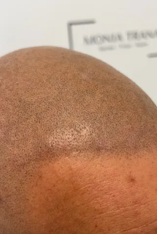 Tricopigmentazione — foto 2 di 2