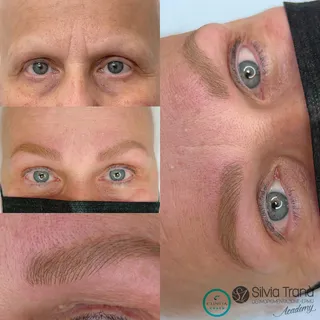 Alopecia — foto 1 di 5