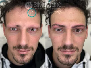 Alopecia — foto 4 di 5