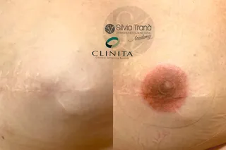 Ricostruzione Areola — foto 3 di 4