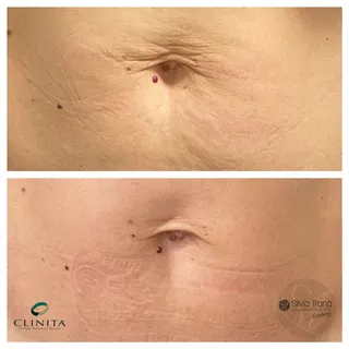 Trattamento Cicatrici — foto 2 di 3