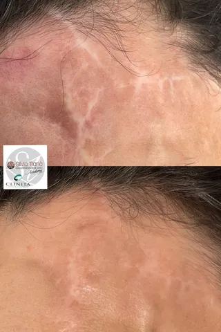 Trattamento Cicatrici — foto 3 di 3